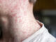 Over 250 people quarantined in South Carolina as measles outbreak rages